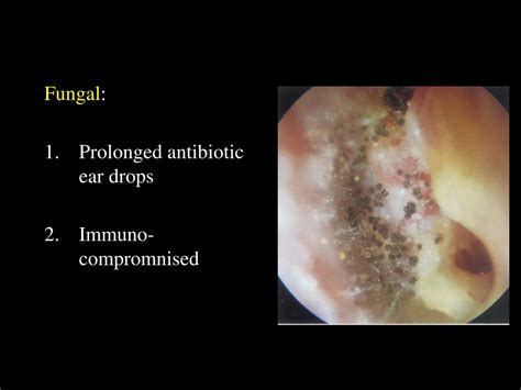 PPT - Diseases of External Ear PowerPoint Presentation, free download - ID:5775117