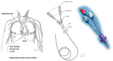 Groshong Catheter Vs Picc Line