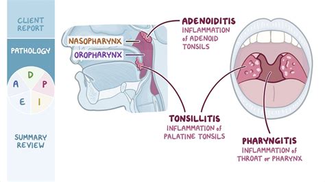 Tonsillitis Types, Causes, Symptoms, Complications,, 57% OFF