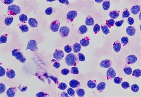 CYTOCHEMICAL STAINS IN HEMATOLOGICAL NEOPLASMS. | Pathology Made Simple