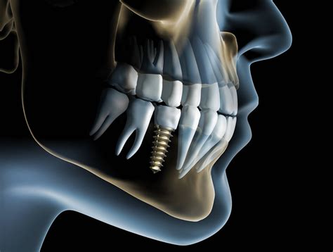 Dental Implants and Bone Loss | Oral & Maxillofacial Associates - OKC