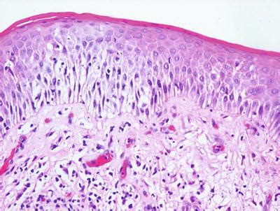 Spongiotic Dermatitis | Plastic Surgery Key