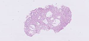 Fundic gland polyp - Libre Pathology