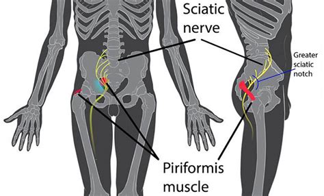 Diagnostico y tratamiento del Síndrome del Piramidal