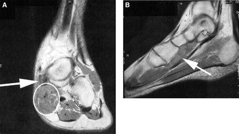 Posterior Tibial Tendon Mri