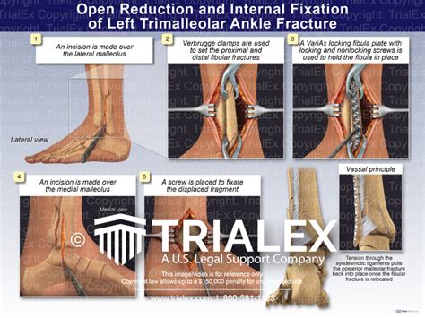 Open Reduction and Internal Fixation of the Left Trimalleolar Ank...