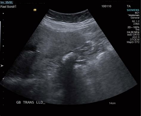 Ultrasound of the gallbladder showing echogenic shadow from the... | Download Scientific Diagram