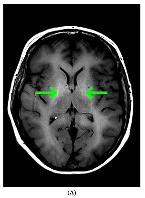 Diagnostics | Free Full-Text | Hepatic Encephalopathy Confirmed by ...