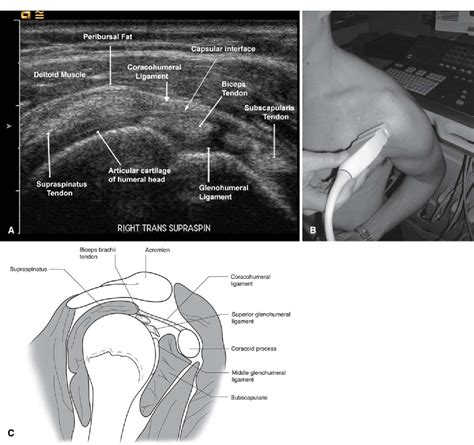 Adhesive capsulitis: sonographic changes in the rotator cuff interval with arthroscopic ...