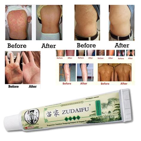 Zudaifu Skin Psoriasis Cream Dermatitis Eczematoid Eczema Ointment ...