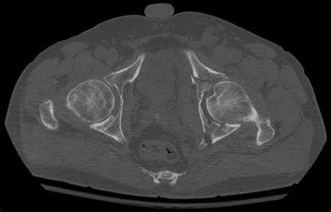 Anterior Column Acetabular Fracture