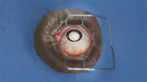 Ophthalmology Case Study - Orbis