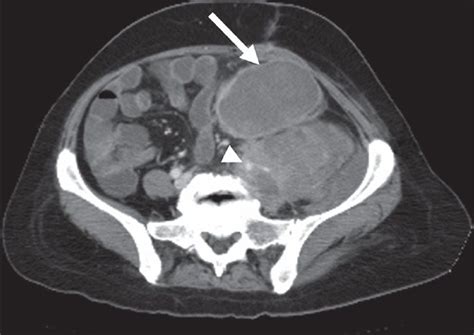 Figure 9: 56-year-old woman with leiomyosarcoma of the left iliac fossa ...