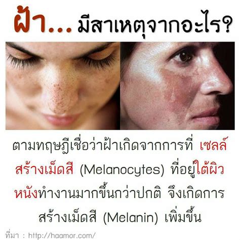 สาเหตุการเกิดฝ้า... - ร้าน สตรอเบอร์รี่ มุกดาหาร