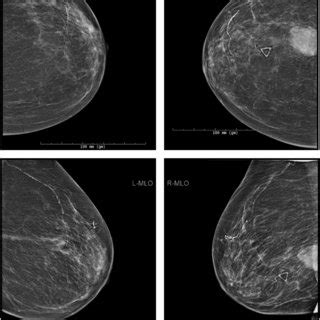 Bilateral diagnostic mammogram at the time of initial evaluation. Top... | Download Scientific ...