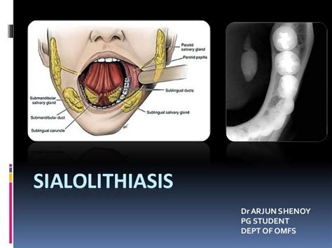 Sialolithiasis and its management in oral and maxillofacial surgery