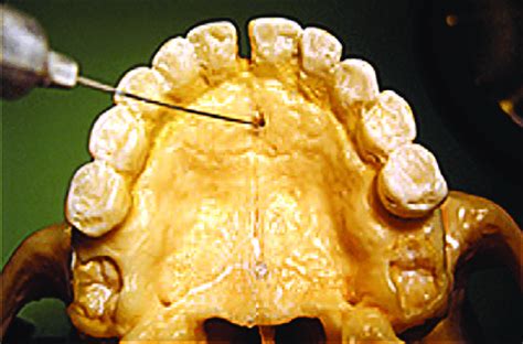 Nasopalatine nerve block | Download Scientific Diagram