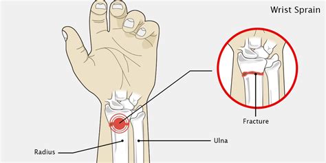 Sprained Wrist - The Complete Injury Guide - Vive Health