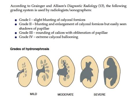 Hydronephrosis grading Vascular Ultrasound, Ultrasound Sonography ...