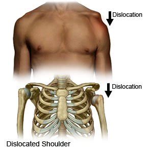 Shoulder Dislocation