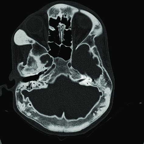 Axial computed tomography image of the skull base in bone window shows... | Download Scientific ...