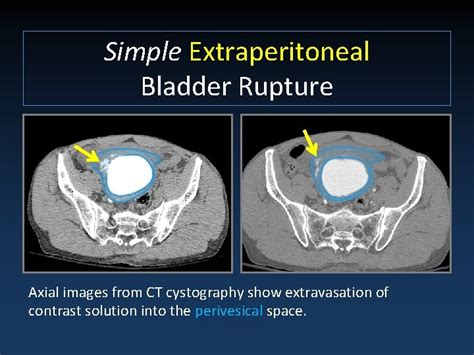 BLADDER INJURY TYPES MECHANISMS AND DIAGNOSTIC IMAGING Jordan