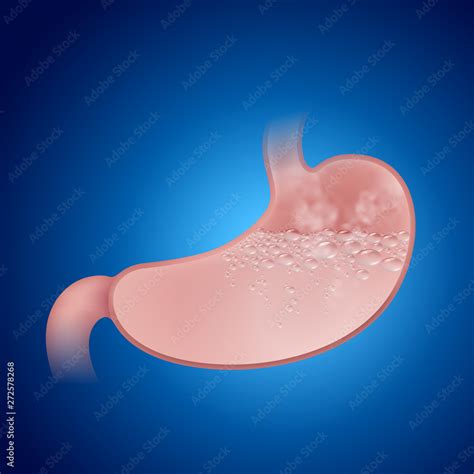 Excess stomach acid causes of acid reflux, gastritis, inflammation. EPS ...