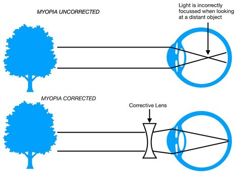 Myopia Series Part 1 - What Causes Myopia? - Artarmon Vision