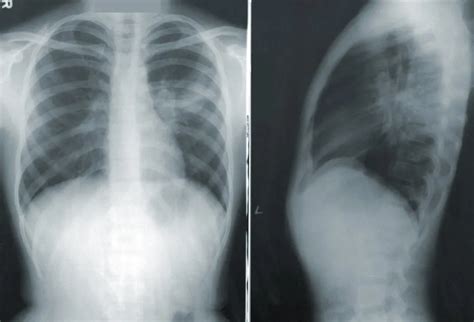 What is Double Pneumonia? How Serious is It? - Elder VIP