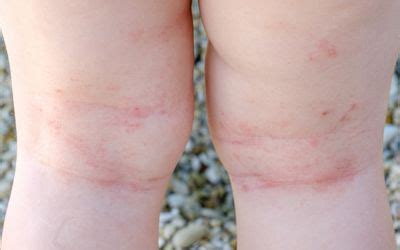 The 3 Stages of Eczema and Their Causes