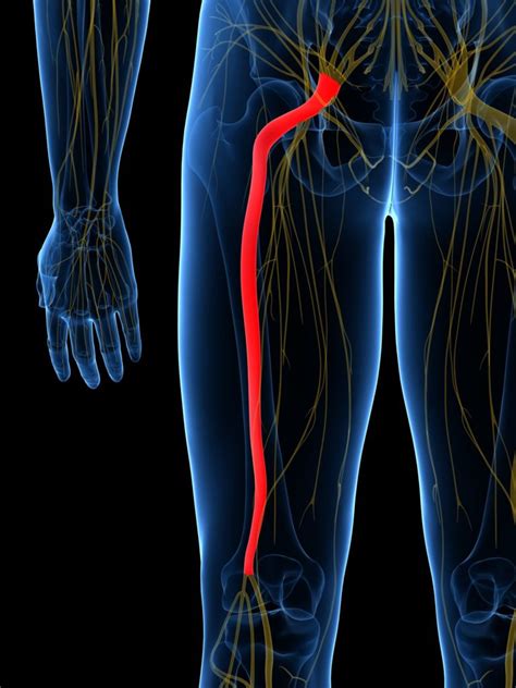 Sciatica: What It Is, Common Causes, and How to Fix It - ARC Health ...