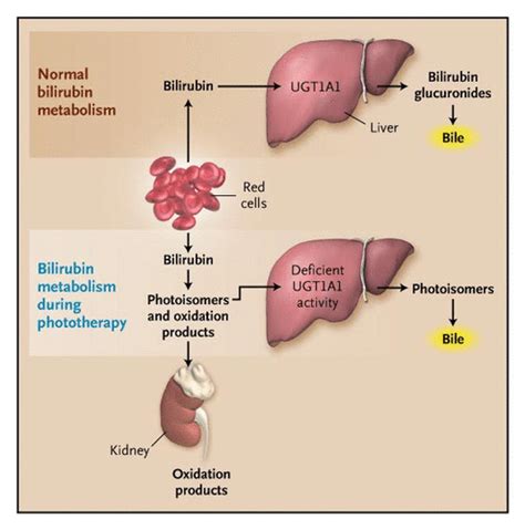 Phototherapy for Neonatal Jaundice | NEJM