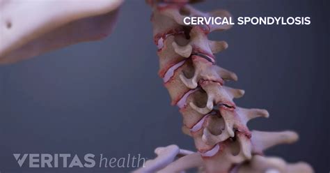 Cervical Spondylosis with Myelopathy Animation