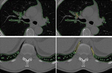 While a professional radiologist agreed with the detected costal and ...