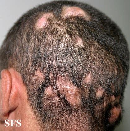 Scalp Problems: Treatment tips for Bumps on scalp