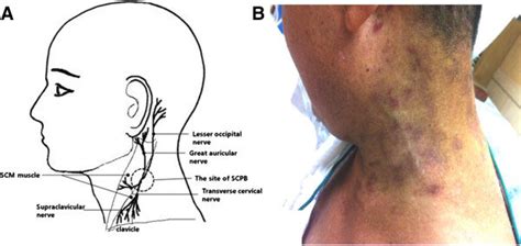 Stellate Ganglion Block Side Effects