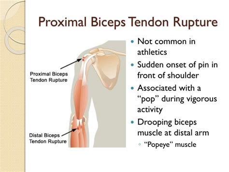 How To Rehab A Complete Ruptured Bicep Tendon