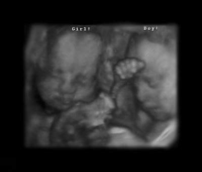 32 weeks old twins ultrasound | Twins ultrasound, How to have twins ...