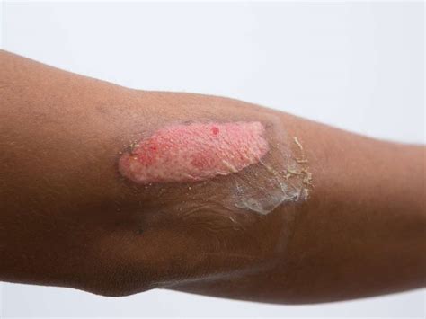 Second-degree burn: Causes, symptoms, and treatment