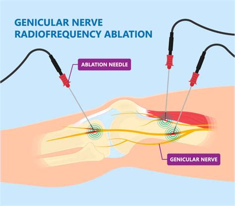 Genicular Nerve Block and Radiofrequency Ablation (RFA) | Excel Pain ...