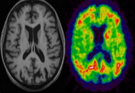 MRI-PET scanner will enable new insights into dementia | Imperial News | Imperial College London