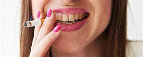 How to remove Tobacco/Nicotine Stains on your Teeth - iSmile - Teeth Whitening Auckland ...