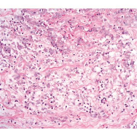 Photomicrograph of necrotic tissue in breast core biopsy with ghosted... | Download Scientific ...