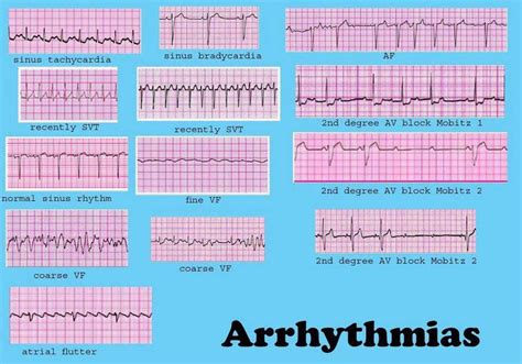 Cardiac Dysrrhythmia (aka Arrhythmia And Irregular Heartbeat) - Electrocardiogram Interpretation ...