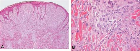 Histology of Spitz nevus. A. Symmetric compound nevus with sharp... | Download Scientific Diagram