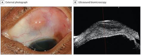 Treatment-Refractory Nodular Scleritis | Hematology | JAMA ...