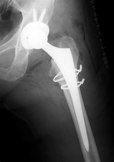 Joint Arthroplasty: a gallery