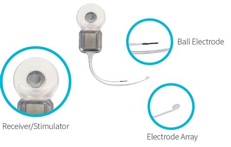 How Does Cochlear Implant Work? - My Baby's Hearing