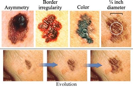 Skin Cancer – Know the Facts | Aspire Hospital