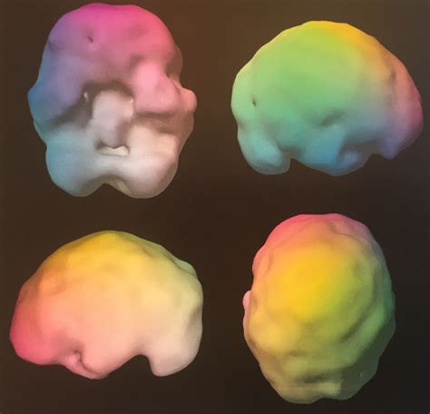 SPECT brain scan - activity - REbrain Clinic